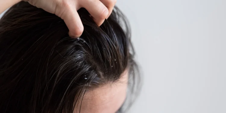 Acabe com a caspa capilar com estas dicas maravilhosas 1 Pessoa com caspa no couro cabeludo coçando a cabeça