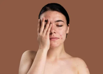 Mulher com acne no rosto, cobrindo parcialmente o rosto com a mão, sobre fundo marrom