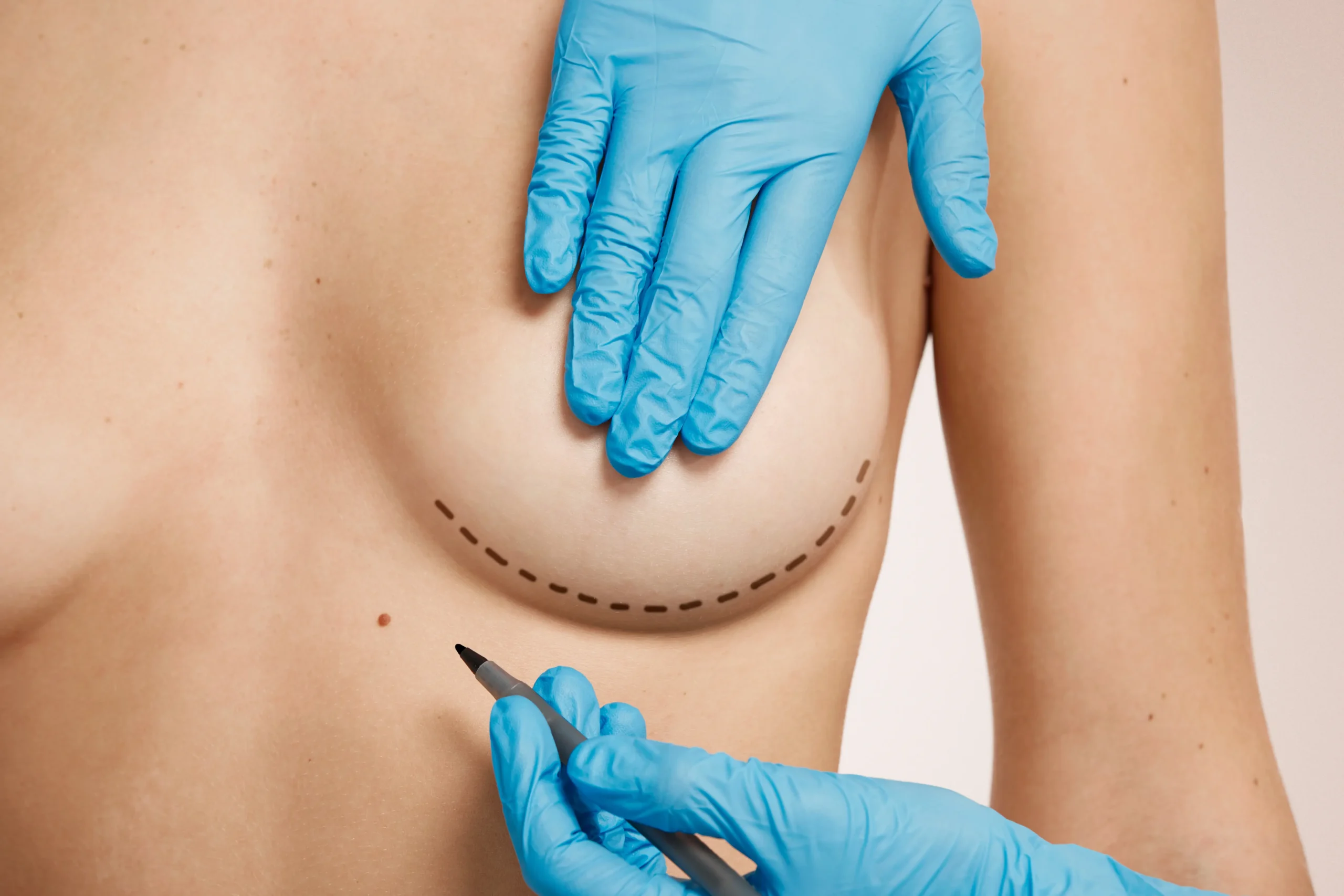 Mulher segurando o implante de silicone, ilustrando o processo cirúrgico de explante.